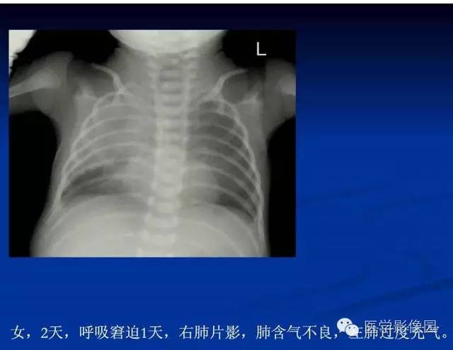 【PPT】新生儿肺部疾病影像学进展