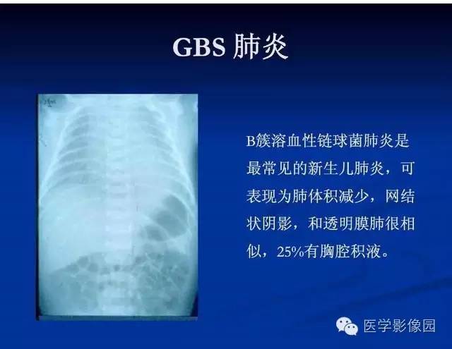 【PPT】新生儿肺部疾病影像学进展