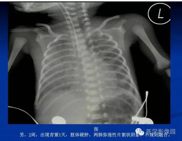 【PPT】新生儿肺部疾病影像学进展