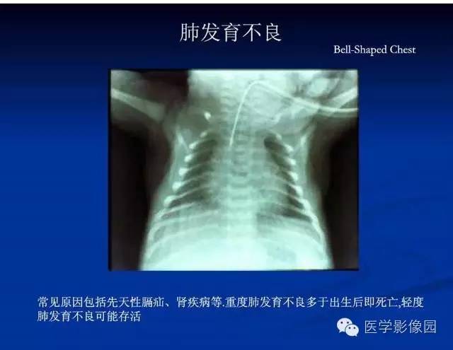 【PPT】新生儿肺部疾病影像学进展