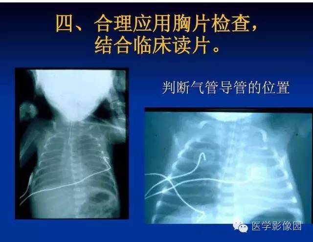 【PPT】新生儿肺部疾病影像学进展