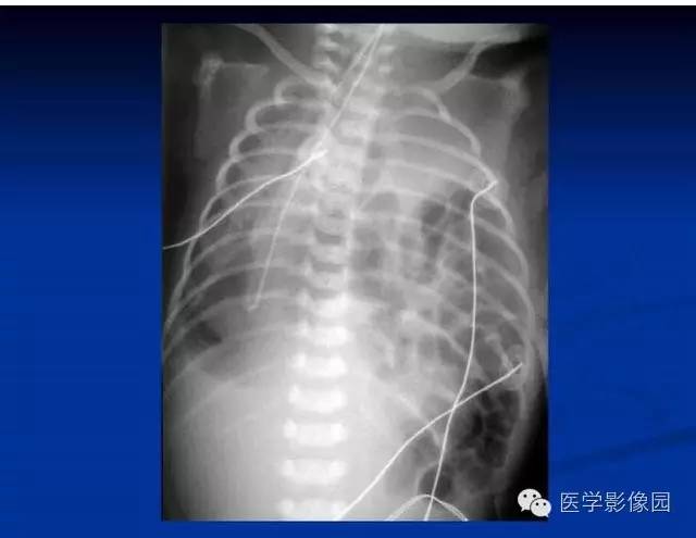 【PPT】新生儿肺部疾病影像学进展