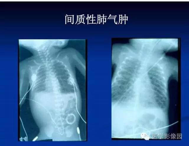 【PPT】新生儿肺部疾病影像学进展