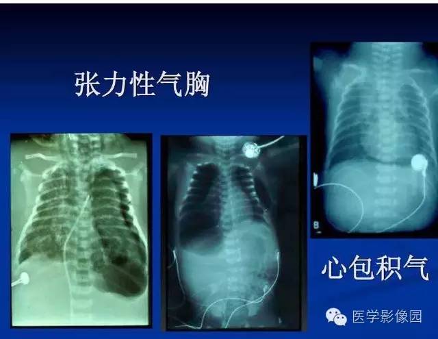 【PPT】新生儿肺部疾病影像学进展