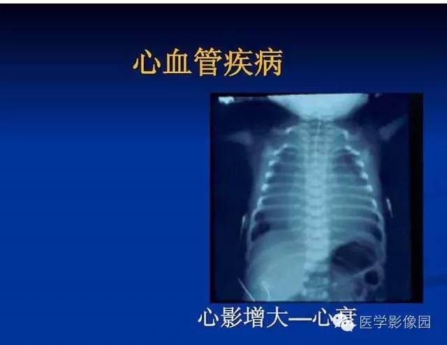 【PPT】新生儿肺部疾病影像学进展