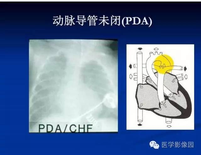 【PPT】新生儿肺部疾病影像学进展