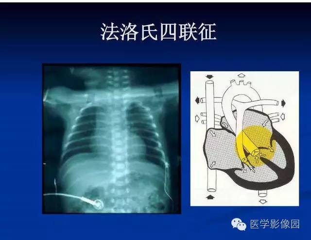 【PPT】新生儿肺部疾病影像学进展