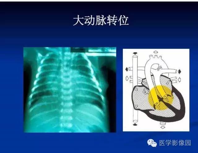【PPT】新生儿肺部疾病影像学进展