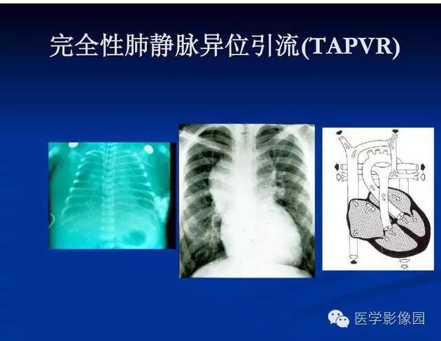 【PPT】新生儿肺部疾病影像学进展