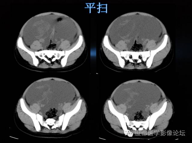 【病例】卵巢颗粒细胞瘤1例 【病例】卵巢颗粒细胞瘤1例