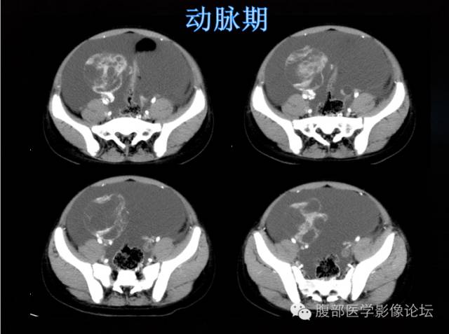 【病例】卵巢颗粒细胞瘤1例 【病例】卵巢颗粒细胞瘤1例