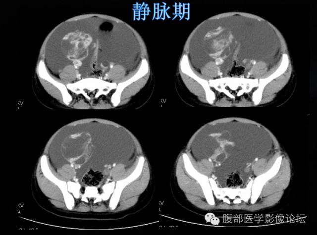 【病例】卵巢颗粒细胞瘤1例 【病例】卵巢颗粒细胞瘤1例
