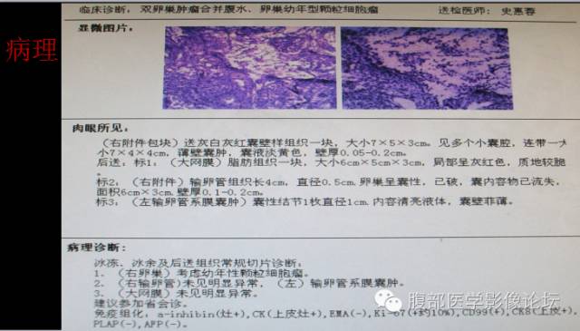 【病例】卵巢颗粒细胞瘤1例 【病例】卵巢颗粒细胞瘤1例