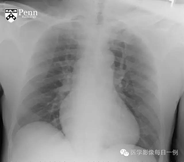 【病例】纵膈血肿1例CT影像表现