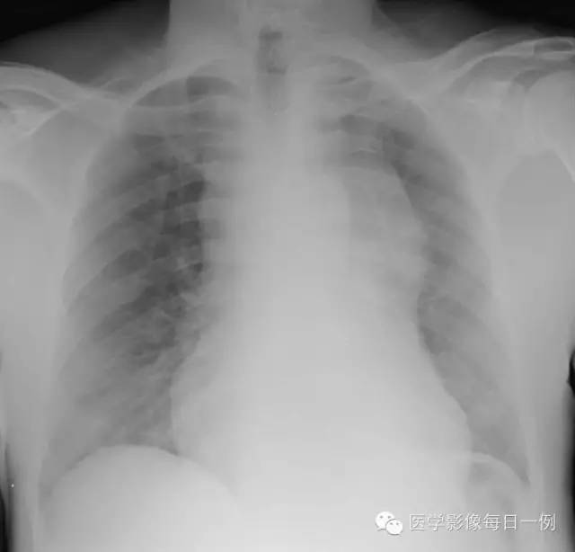 【病例】纵膈血肿1例CT影像表现