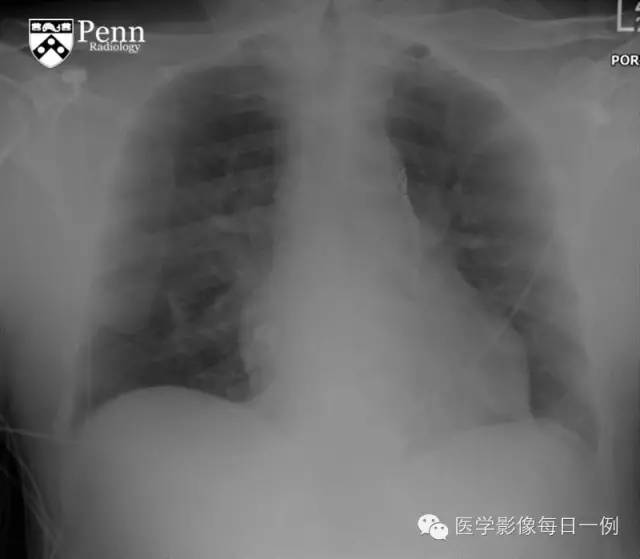 【病例】纵膈血肿1例CT影像表现