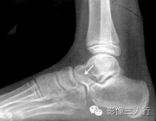 "食蚁兽鼻征"，这个征象提示啥？