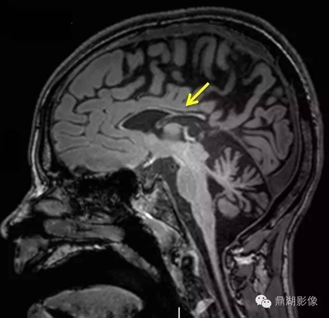 【病例】萨拉病1例MR影像表现 【病例】萨拉病1例MR影像表现