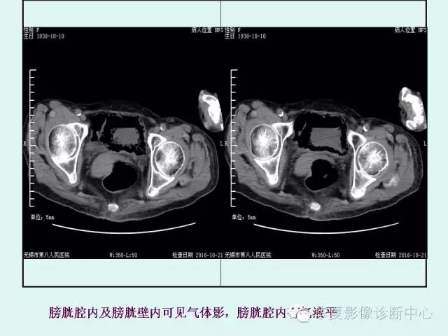 【PPT】气肿性膀胱炎