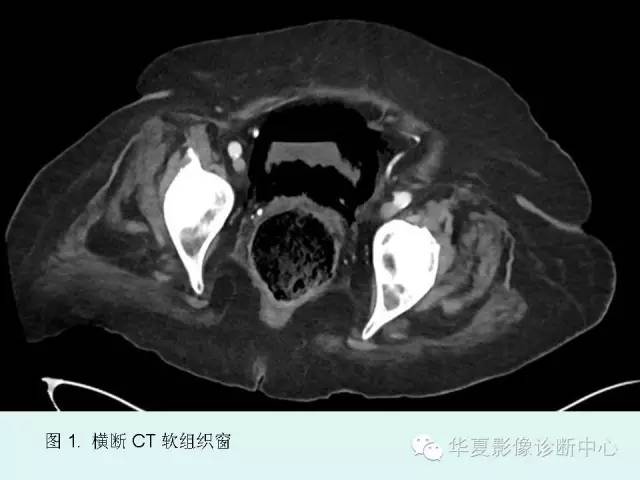 【PPT】气肿性膀胱炎