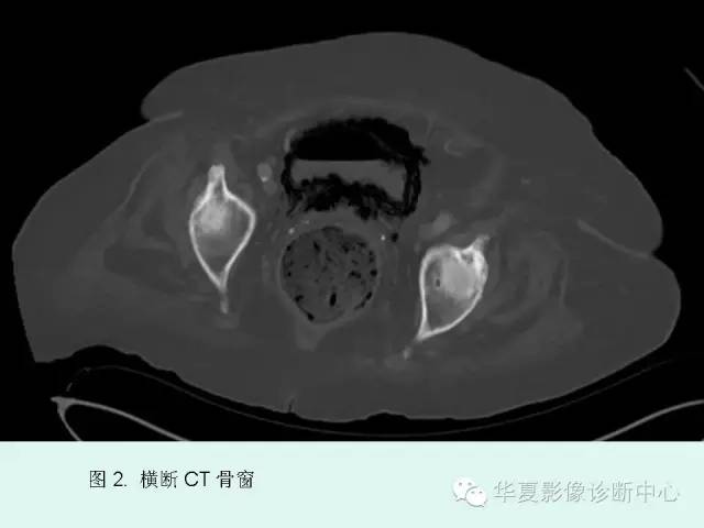 【PPT】气肿性膀胱炎