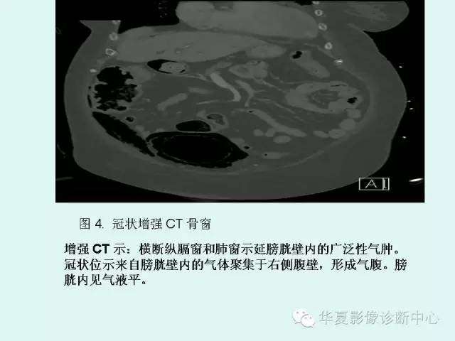 【PPT】气肿性膀胱炎