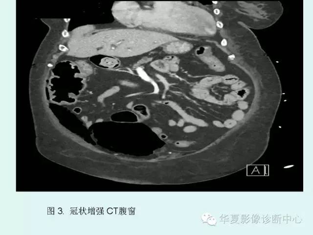 【PPT】气肿性膀胱炎