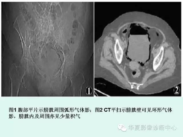 【PPT】气肿性膀胱炎