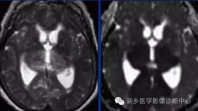基底动脉综合征