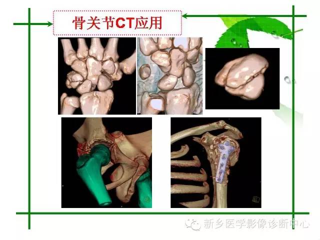 【PPT】CT和MR在骨与关节疾病的临床应用