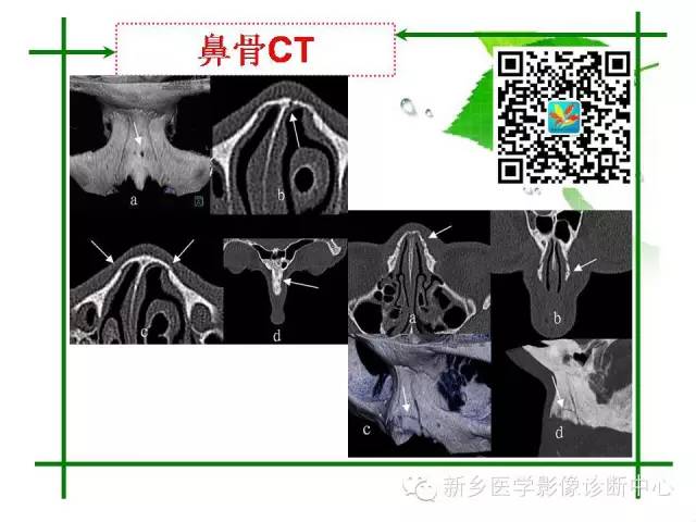 【PPT】CT和MR在骨与关节疾病的临床应用
