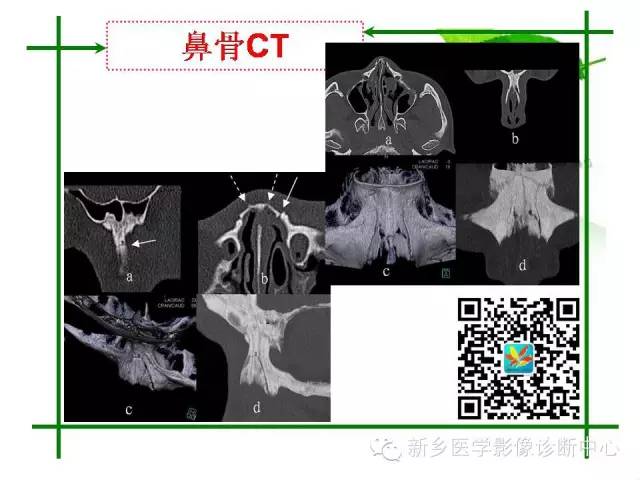 【PPT】CT和MR在骨与关节疾病的临床应用