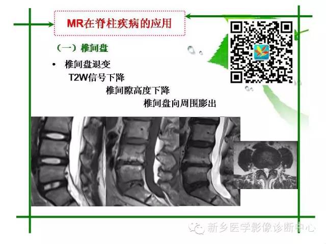 【PPT】CT和MR在骨与关节疾病的临床应用