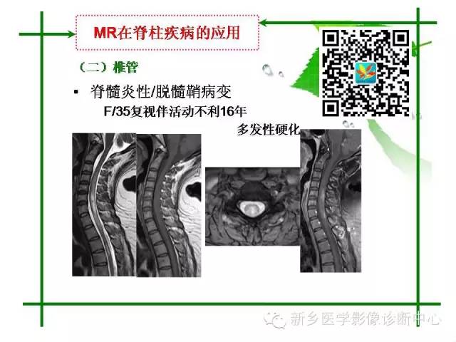 【PPT】CT和MR在骨与关节疾病的临床应用