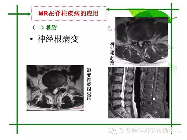 【PPT】CT和MR在骨与关节疾病的临床应用