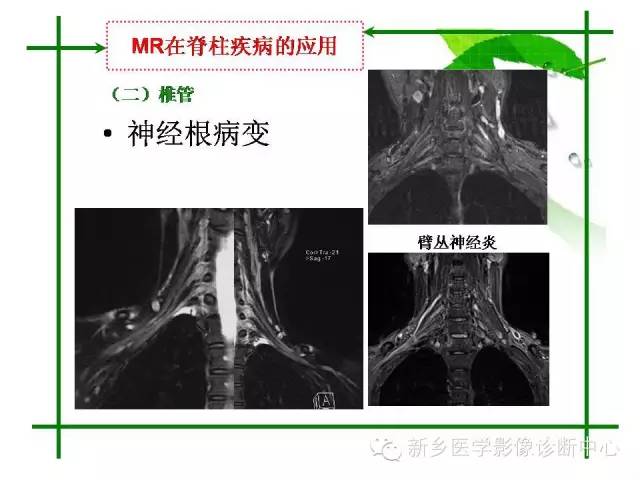 【PPT】CT和MR在骨与关节疾病的临床应用