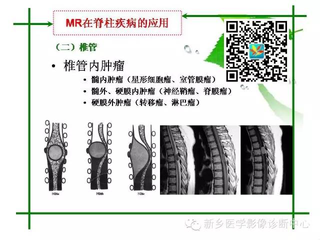 【PPT】CT和MR在骨与关节疾病的临床应用