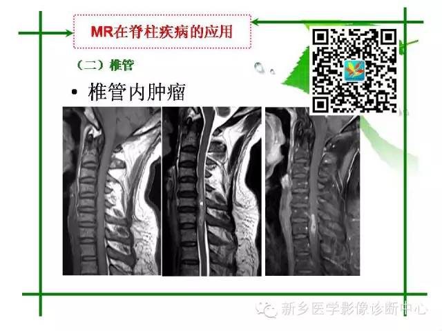 【PPT】CT和MR在骨与关节疾病的临床应用