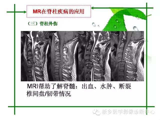 【PPT】CT和MR在骨与关节疾病的临床应用