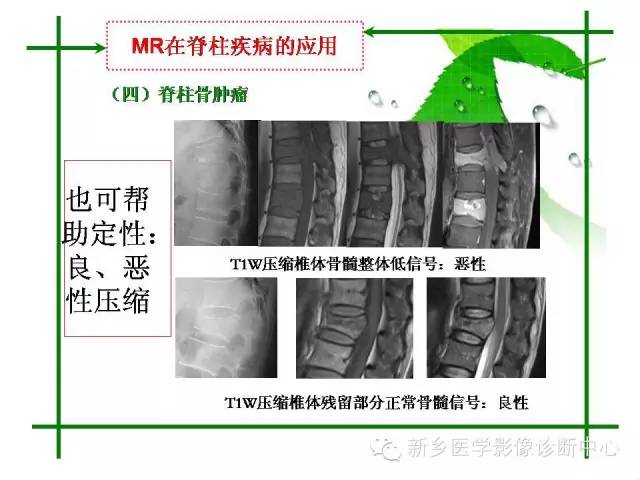 【PPT】CT和MR在骨与关节疾病的临床应用