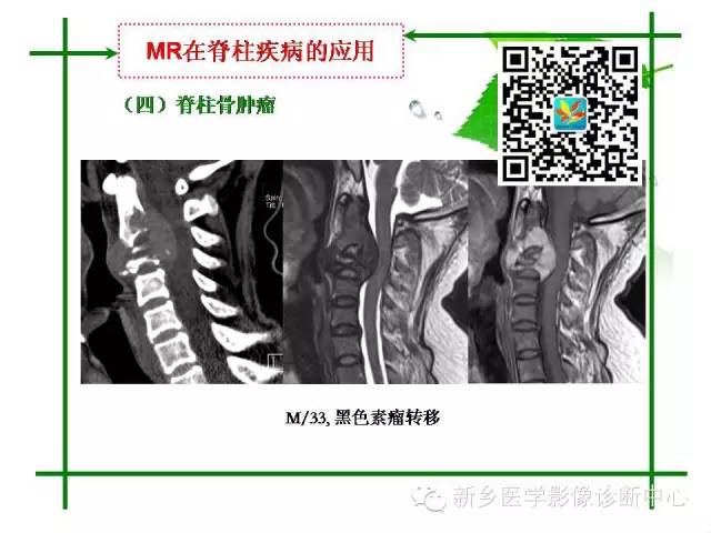 【PPT】CT和MR在骨与关节疾病的临床应用