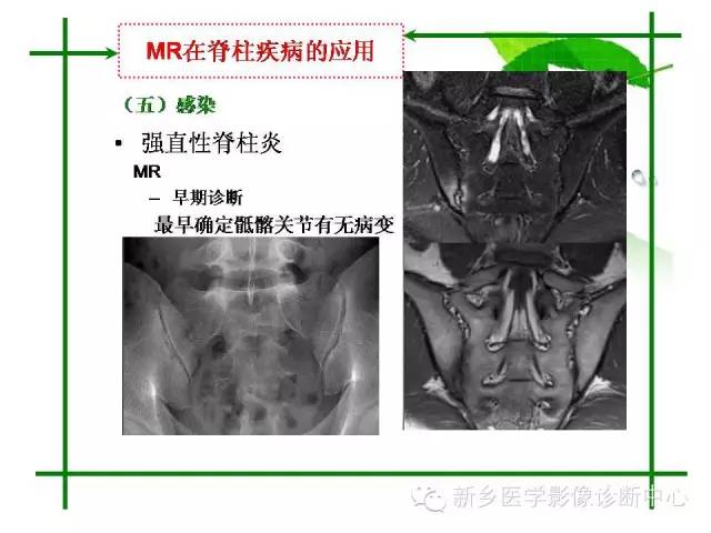 【PPT】CT和MR在骨与关节疾病的临床应用