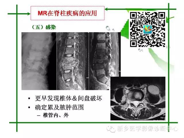 【PPT】CT和MR在骨与关节疾病的临床应用