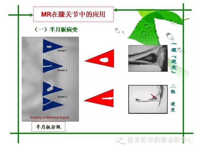 【PPT】CT和MR在骨与关节疾病的临床应用