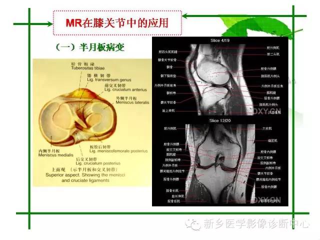 【PPT】CT和MR在骨与关节疾病的临床应用