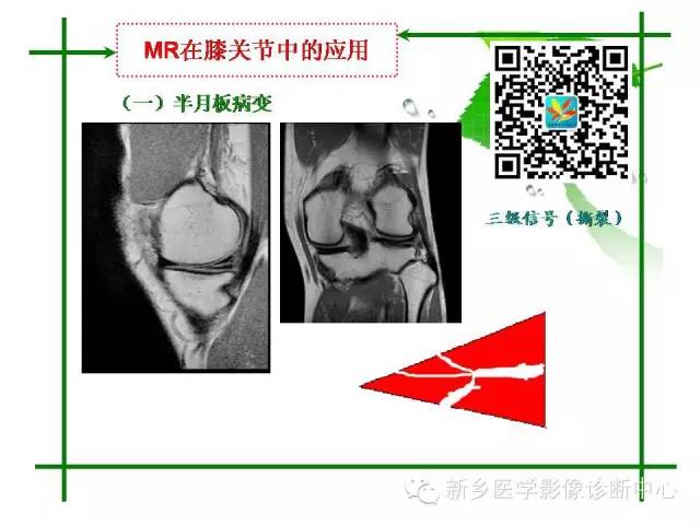 【PPT】CT和MR在骨与关节疾病的临床应用