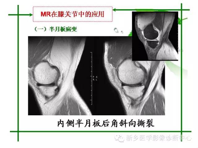 【PPT】CT和MR在骨与关节疾病的临床应用