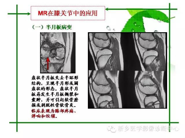 【PPT】CT和MR在骨与关节疾病的临床应用