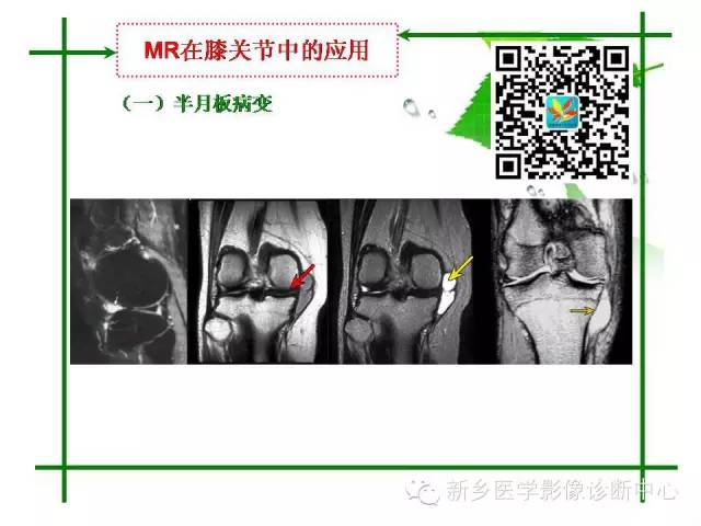 【PPT】CT和MR在骨与关节疾病的临床应用
