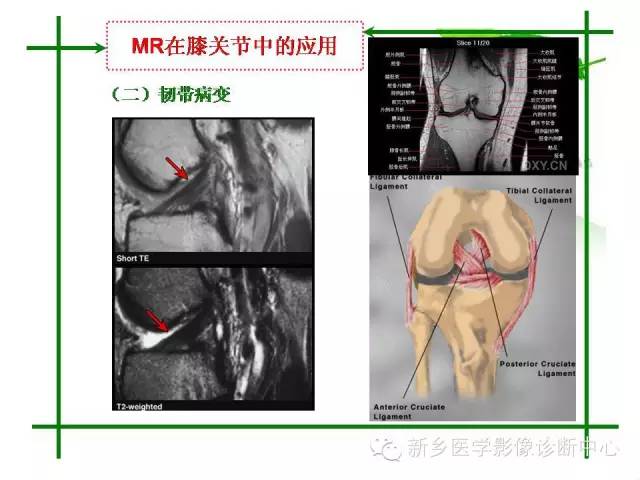 【PPT】CT和MR在骨与关节疾病的临床应用